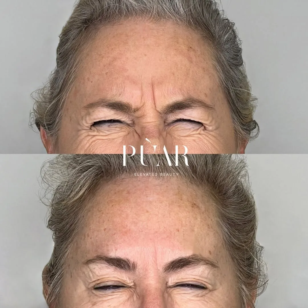 Before and after result at PÙAR, Lake Mary. Individual results vary.