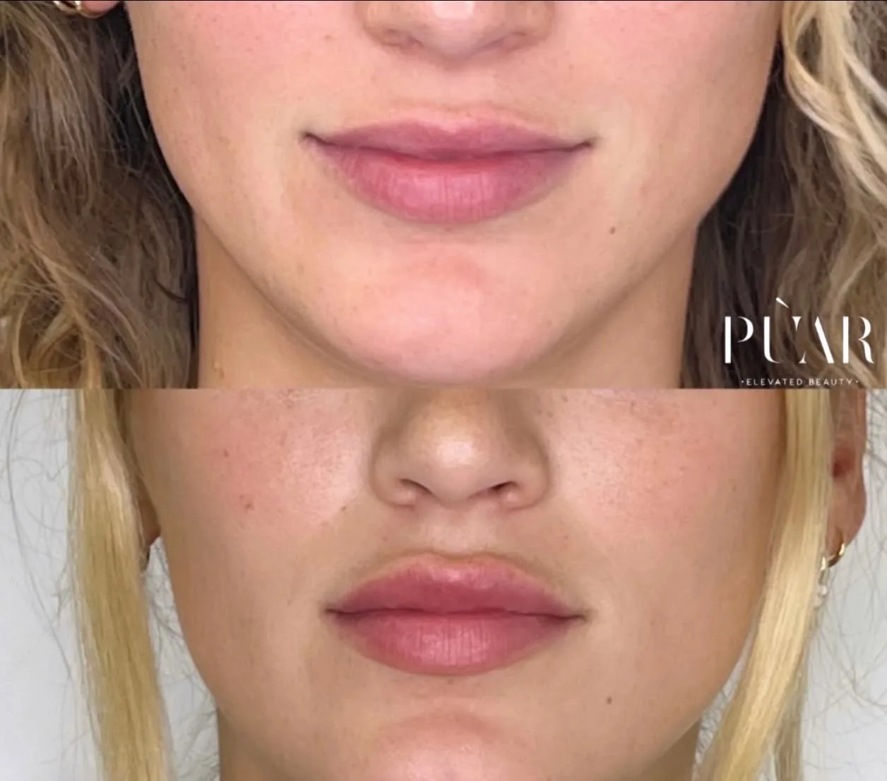 Before and after result at PÙAR, Lake Mary. Individual results vary.