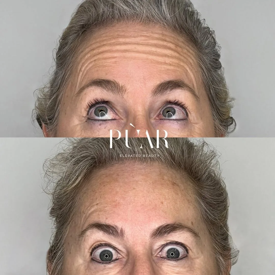 Before and after result at PÙAR, Lake Mary. Individual results vary.
